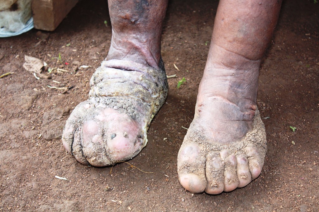 Neglected Tropical Diseases in Uganda: A Persistent Challenge with Hope on the Horizon